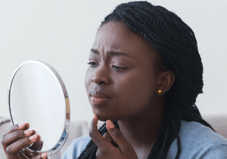 How to Treat Acne - ML Aesthetic Medicine Montreal - ML Aesthetic Clinic
