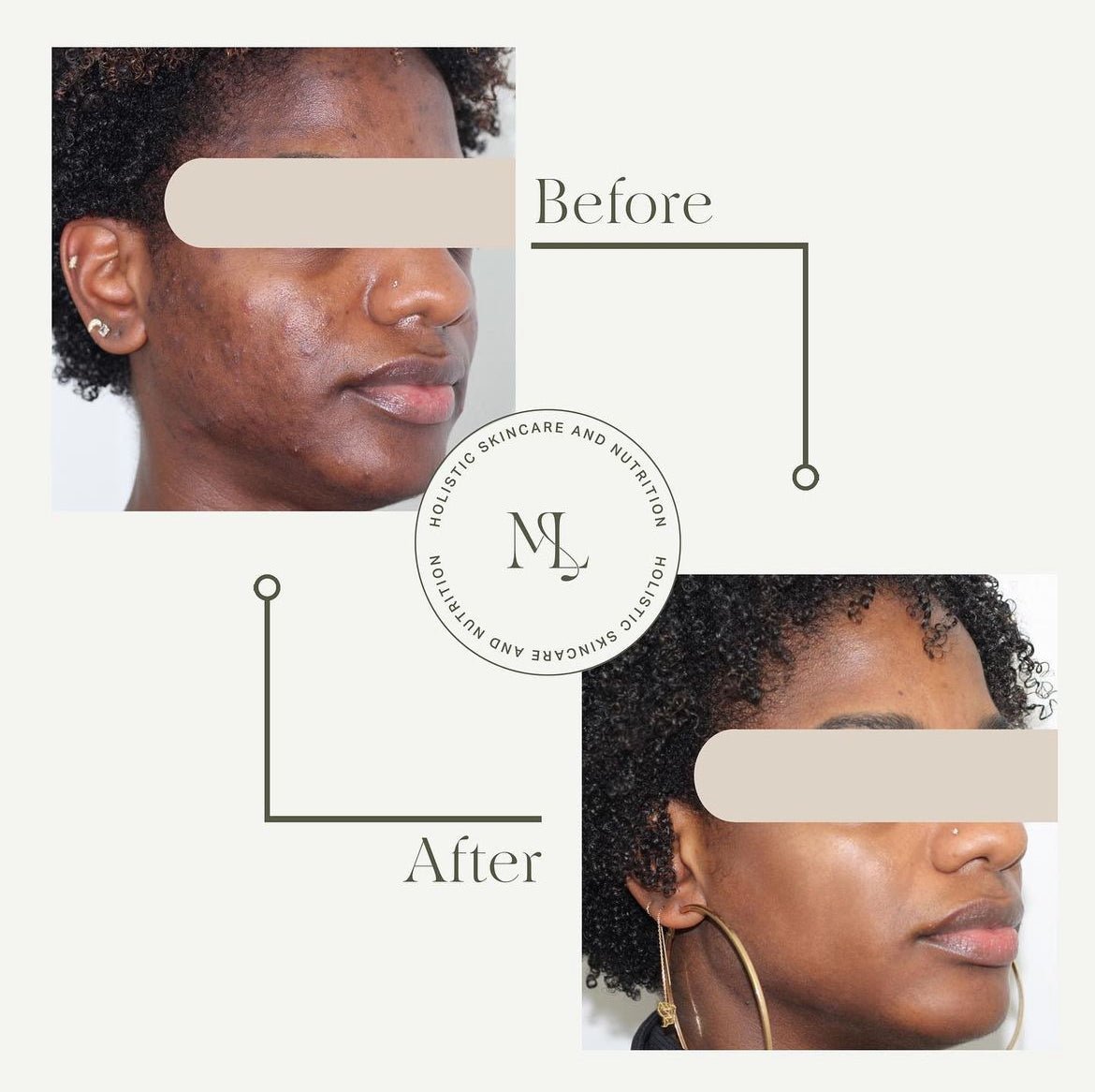 Acne Bootcamp - ML Aesthetic - ML Aesthetic Clinic