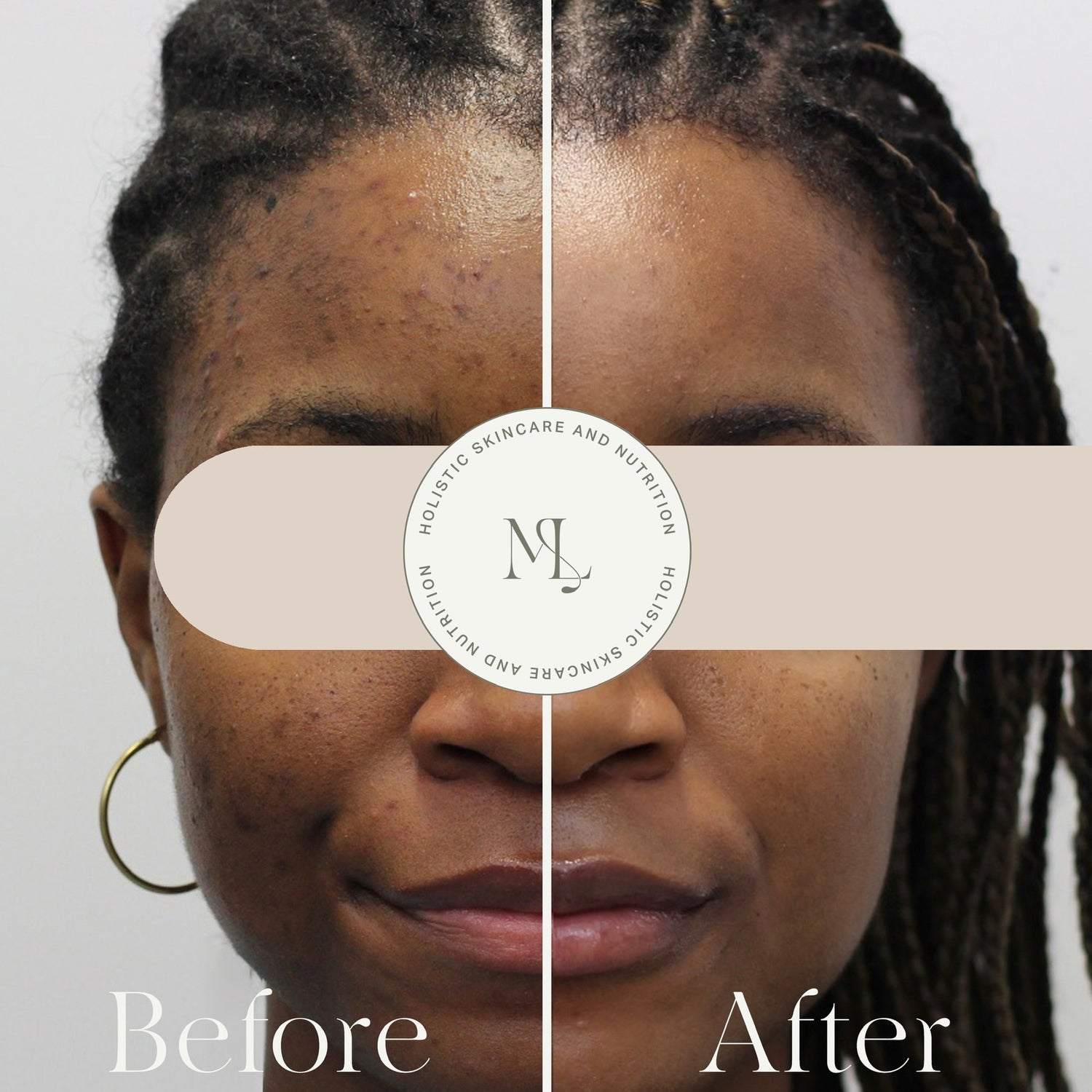 Dark Spot Bootcamp - 3 - Month Intensive Hyperpigmentation Treatment in Montreal - ML Aesthetic Clinic