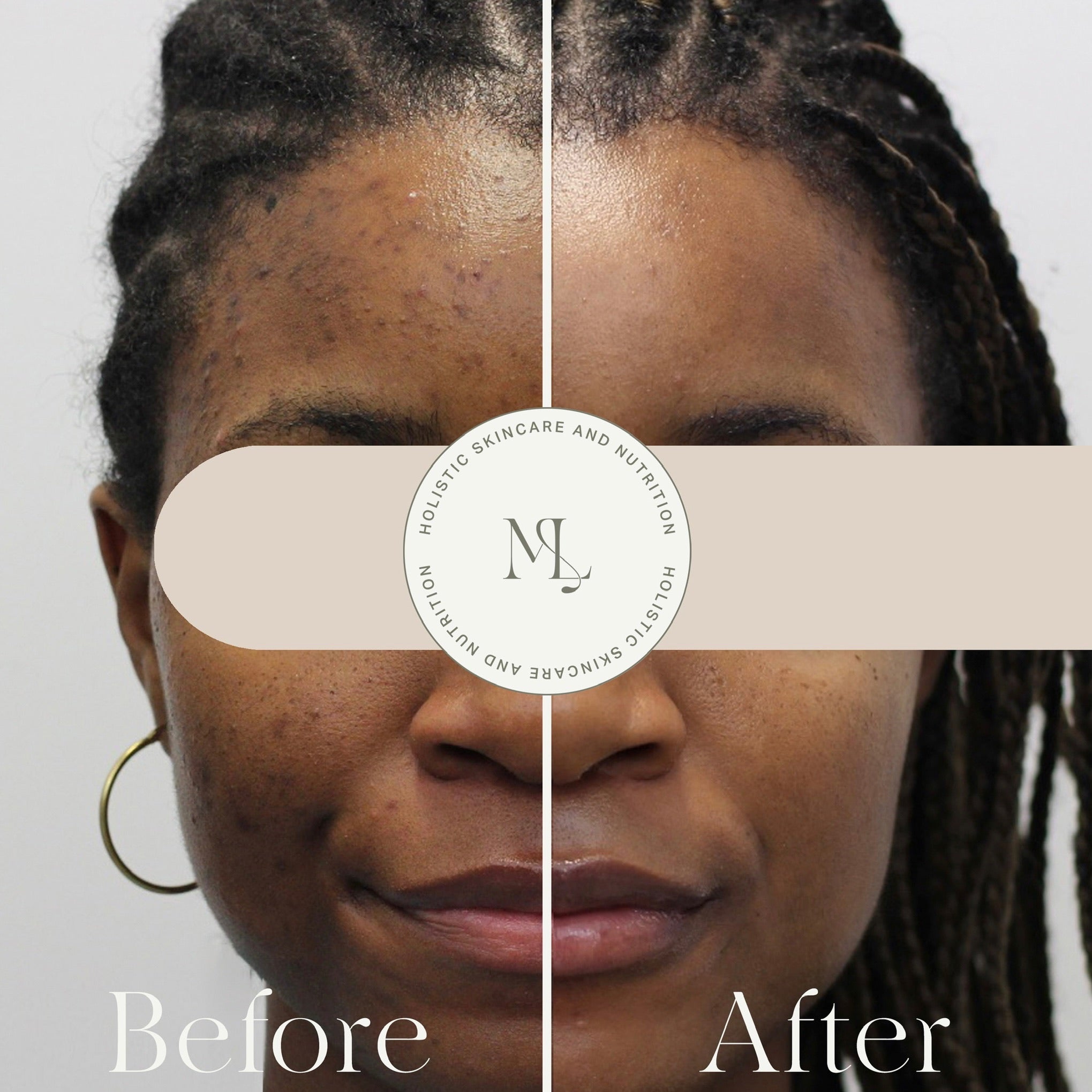 Dark Spot Bootcamp - 3 - Month Intensive Hyperpigmentation Treatment in Montreal - ML Aesthetic Clinic