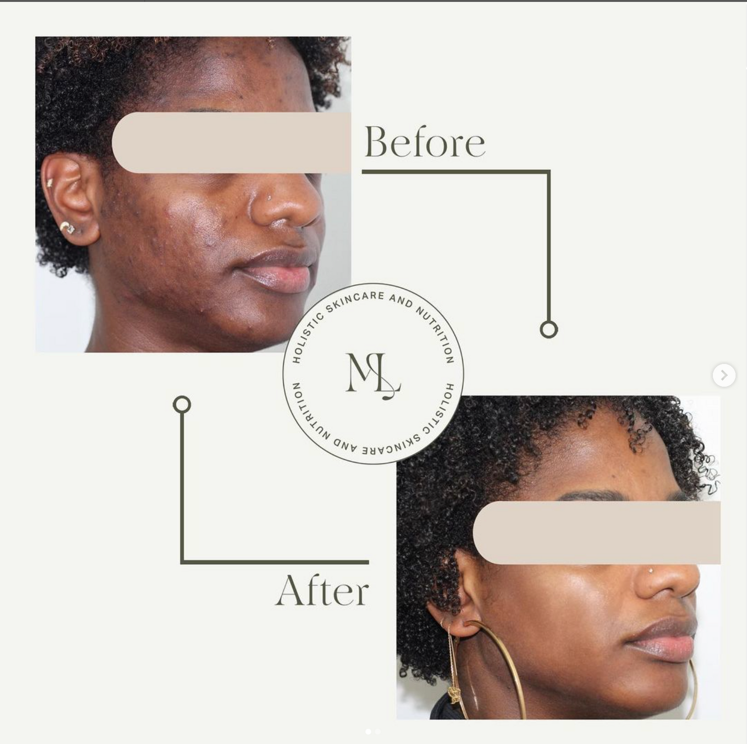 Non Inflamed Acne Routine - ML Aesthetic Clinic